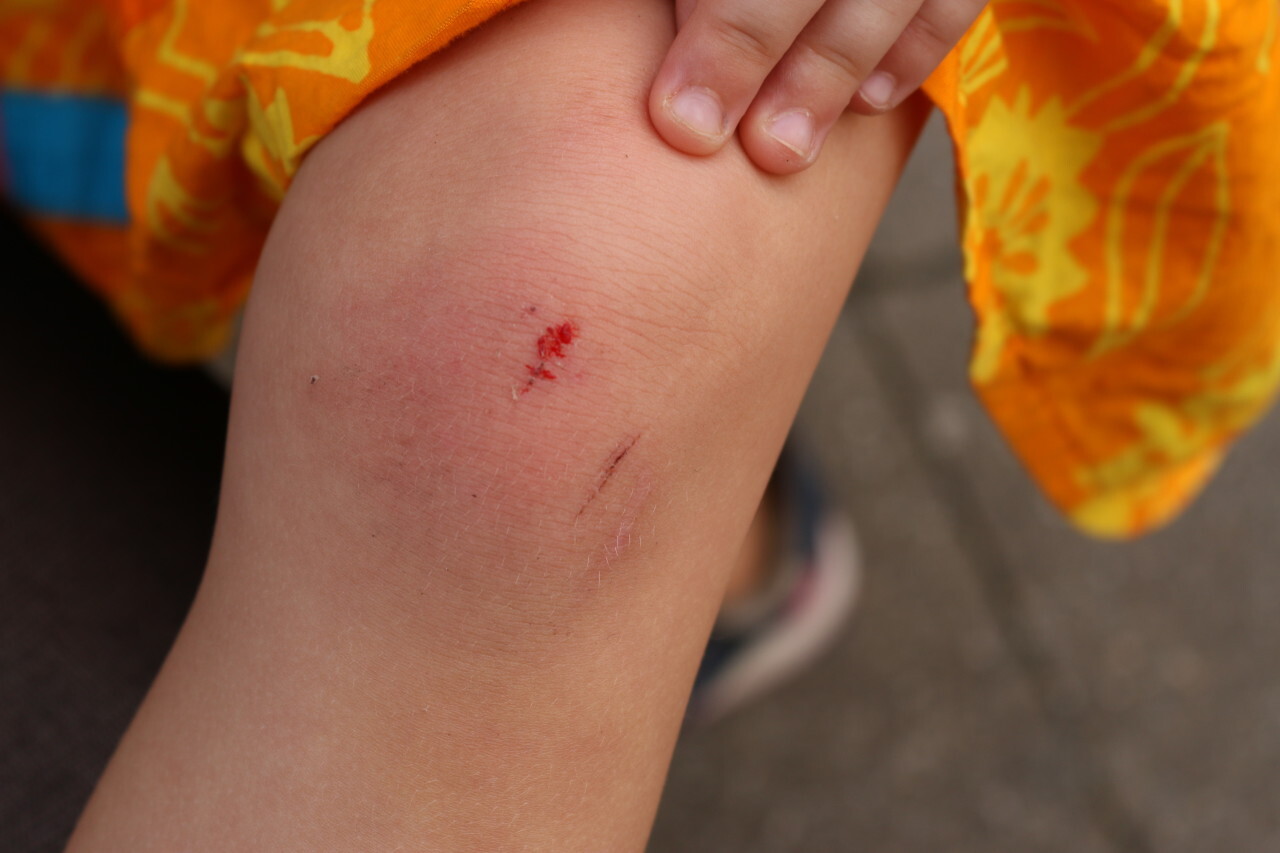 Child with scraped knee has hurt