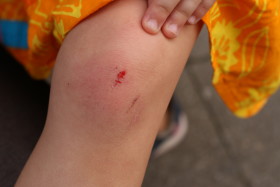 Stock Image: Child with scraped knee has hurt